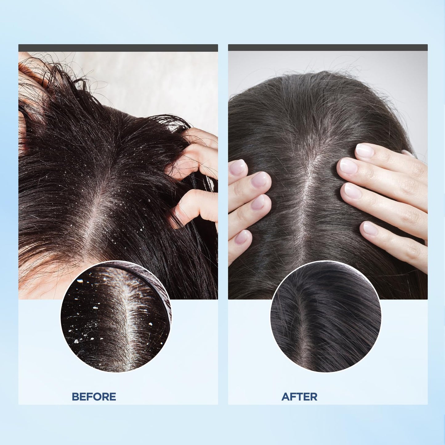 Bablabear Scalp Exfoliator Scrub,Itchy Scalp Treatment for Dandruff, No Sulfate Hair Scrub To Soothe a Dry, Flaky,Scalp,Removes Buildup,Clarifying Shampoo With Scrubber
